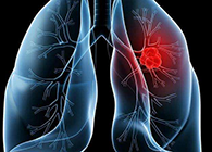 【Nature】非小细胞肺癌治疗新方案：靶向降解EGFR